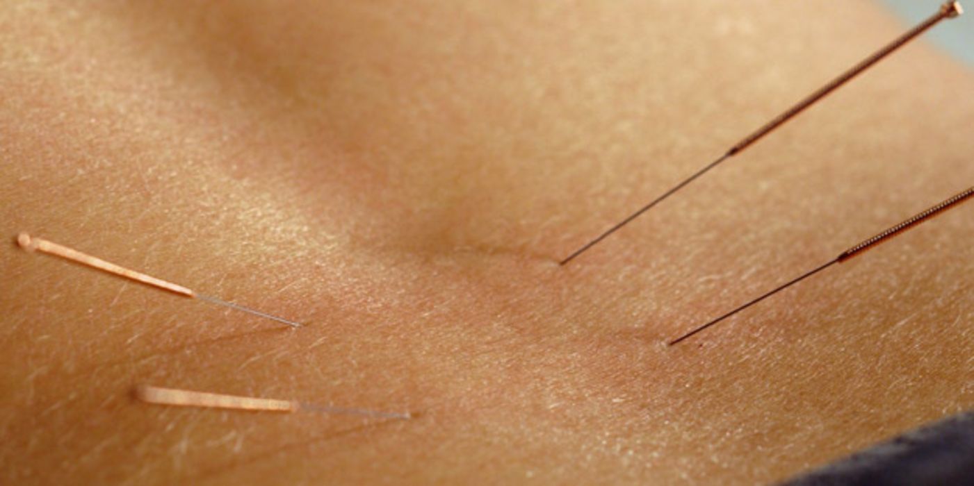 Akupunkturnadeln in der Haut eines Patienten