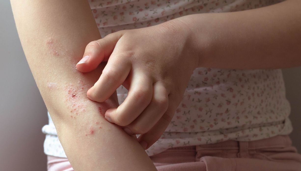 Mädchen, kratzt sich am Arm.