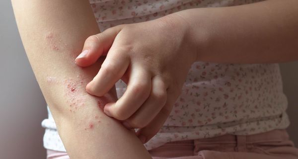 Mädchen, kratzt sich am Arm.