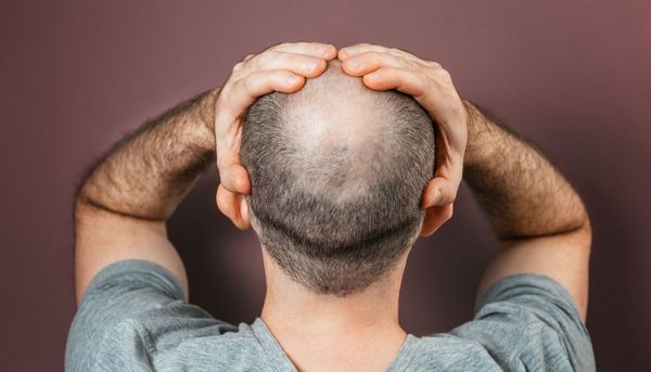 Desoxyribose: Wie ein Zuckergel gegen Haarausfall wirkt