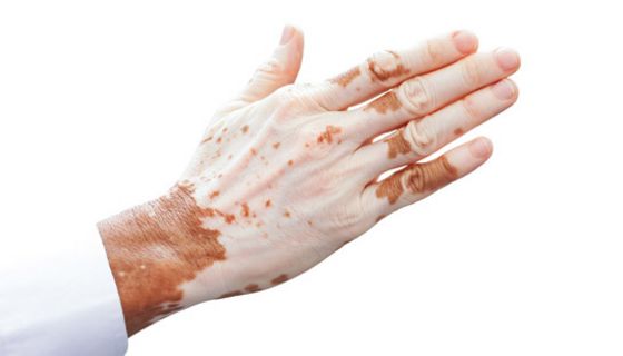 Bei Vitiligo werden die Pigmentzellen der Haut, die den dunklen Farbstoff tragen, zerstört.