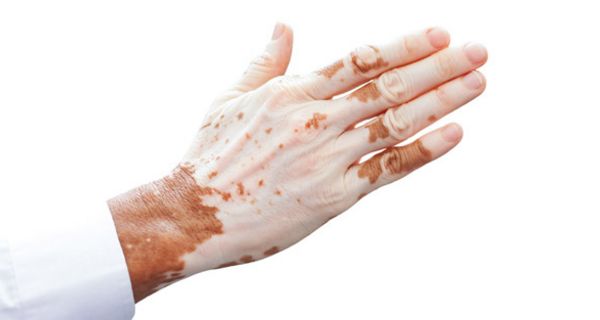 Bei Vitiligo werden die Pigmentzellen der Haut, die den dunklen Farbstoff tragen, zerstört.