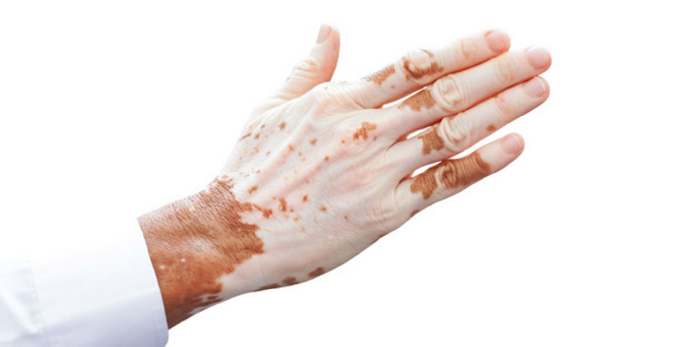 Bei Vitiligo werden die Pigmentzellen der Haut, die den dunklen Farbstoff tragen, zerstört.
