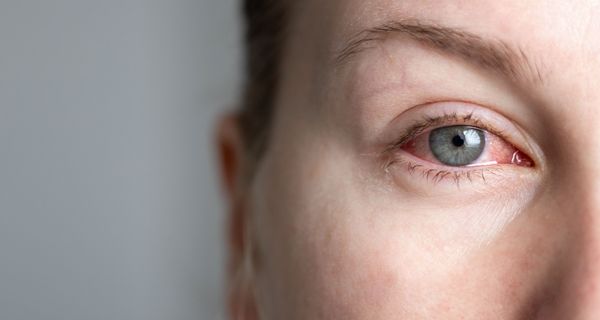 Rotes Auge.