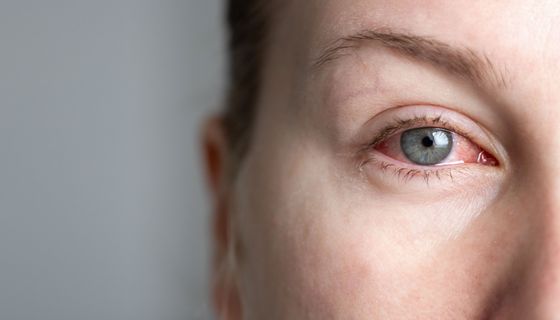 Rotes Auge.
