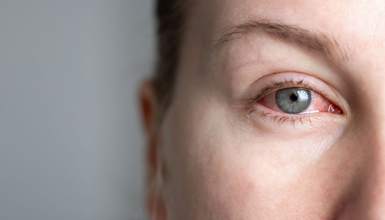 Rotes Auge.