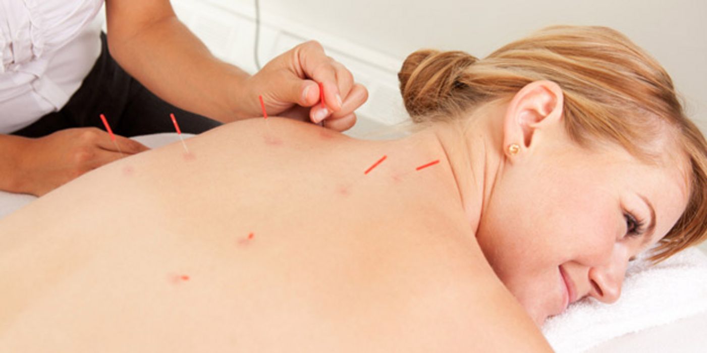 Blonde Frau um die 40, auf dem Bauch liegend, bekommt im Schulterbereich Akupunkturnadeln gesetzt